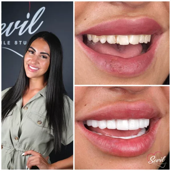 Before and after lip-level frames of a fifth patient, shown at the source photograph's own resolution
