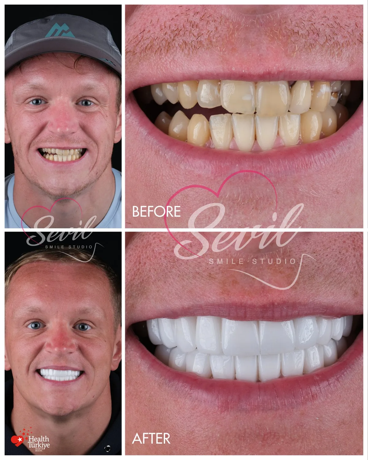 Before and after frames of a patient treated at our Istanbul clinic, photographed at face and lip level