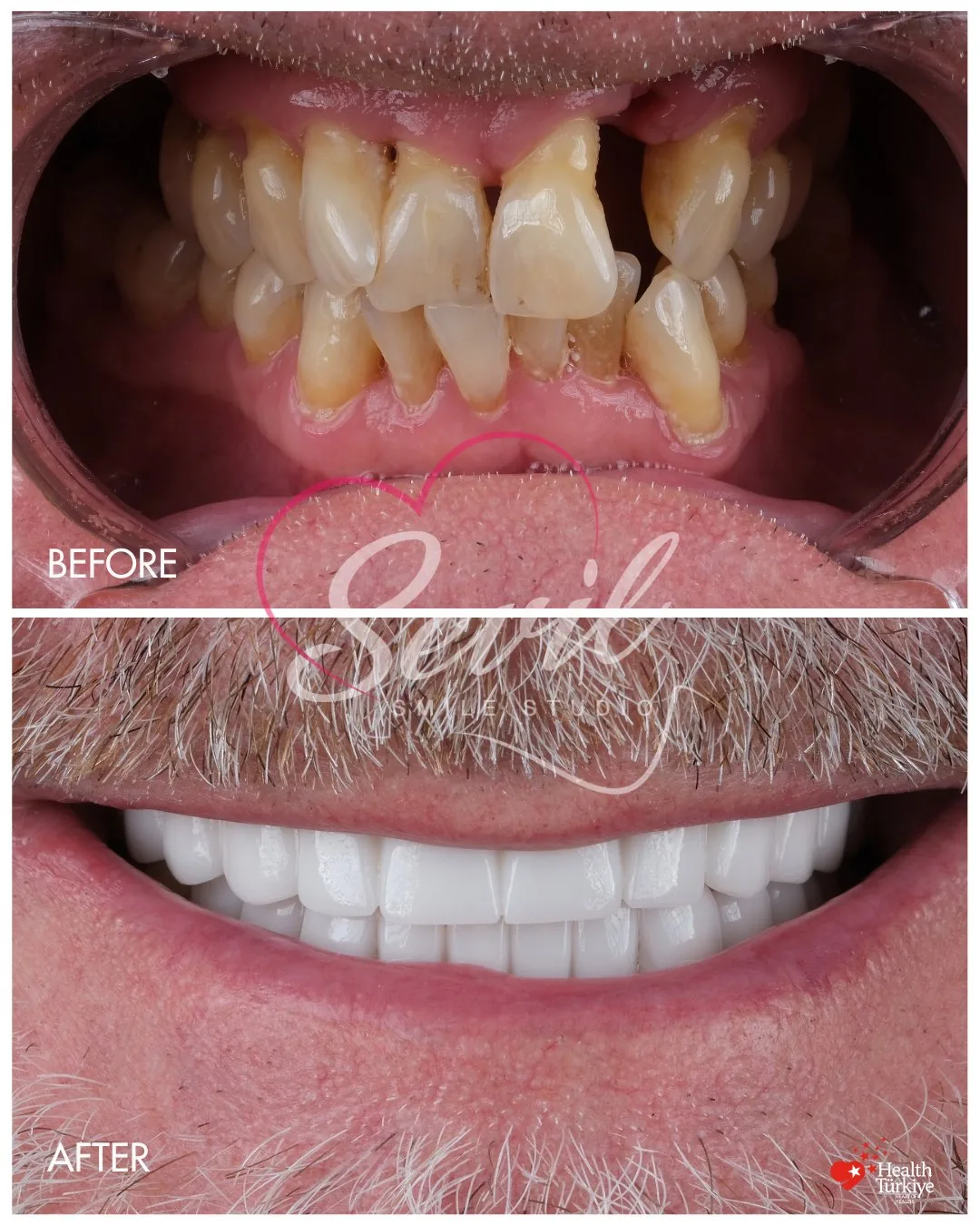 Intraoral before and after frames of a third patient's crowded and spaced teeth, then a full-arch restoration