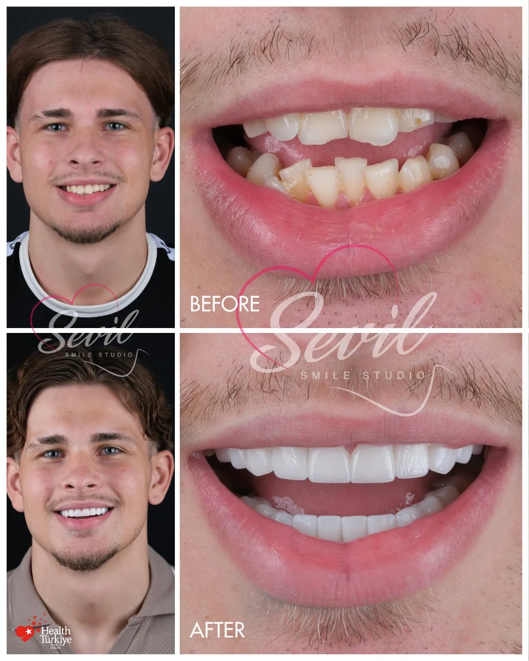 Before and after frames of a second patient treated at our Istanbul clinic, photographed at face and lip level