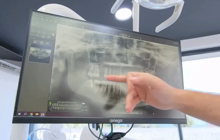 A clinician pointing at a panoramic X-ray on a treatment-room monitor